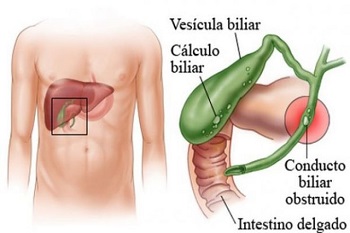 cirugia-de-vesicula