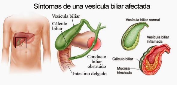 Piedras en la vesícula