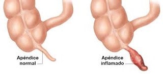 sintomas-de-apendicitis